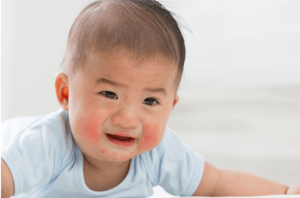 Handle Skin Allergies in Kids