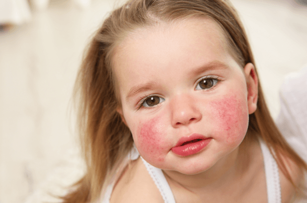Handle Skin Allergies in Kids