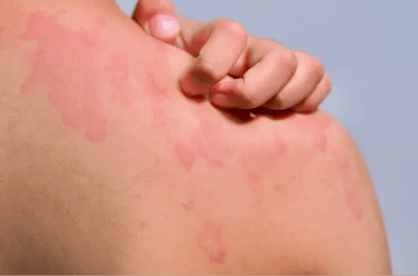 Skin Infections in Children